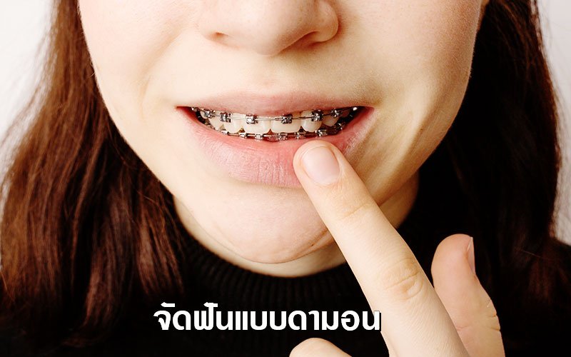 จัดฟันแบบดามอน
