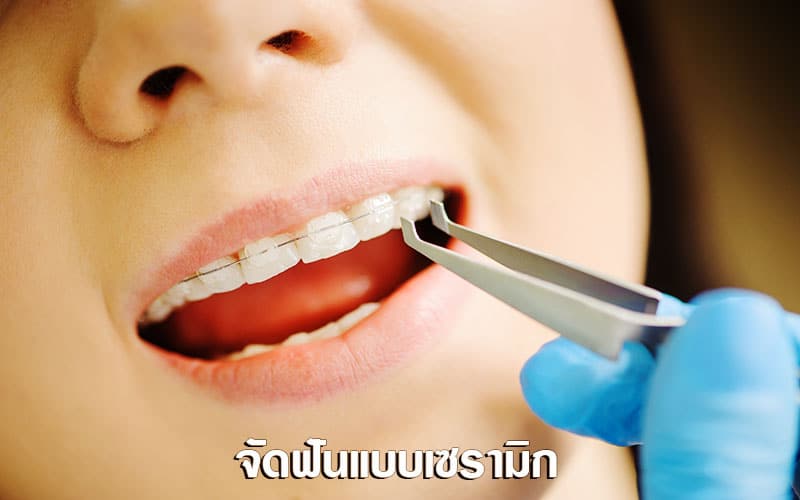 จัดฟันแบบเซรามิก