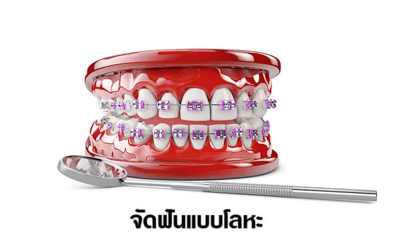 จัดฟันแบบโลหะ